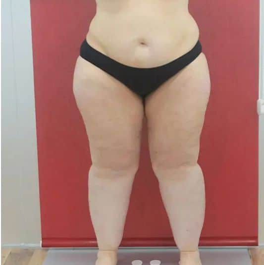 ¿Problemas circulatorios en las piernas? Podrían ser síntomas de lipedema